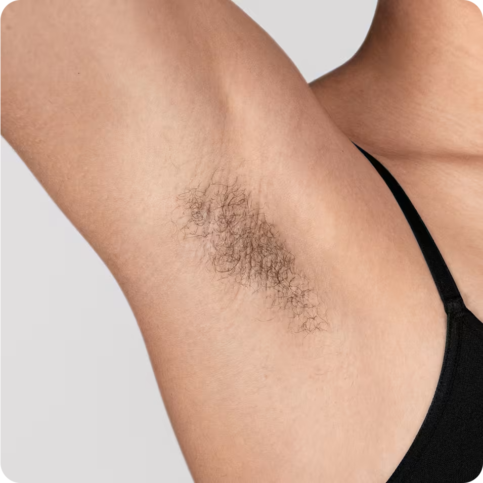 Woman's underarm before first session