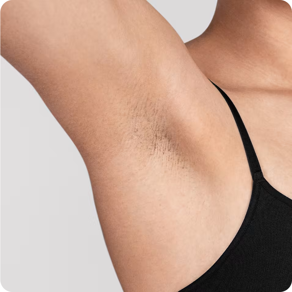 Woman's underarm after 3 sessions