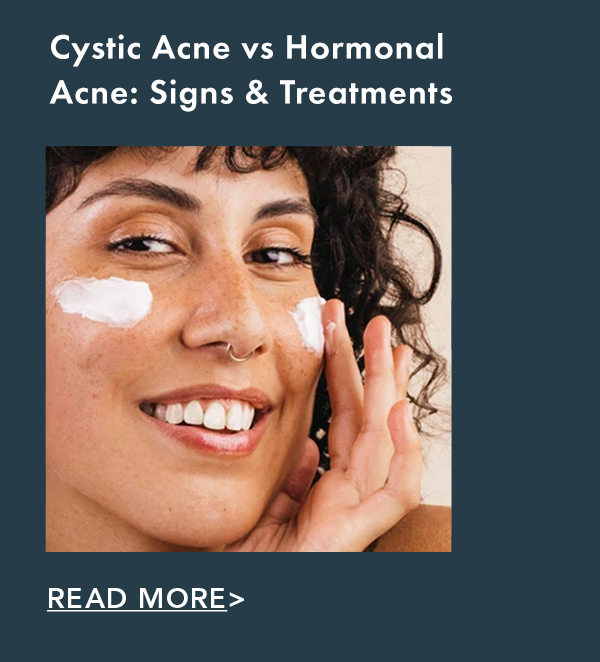 Cystic Acne vs Hormonal Acne: Signs & Treatments. Read More.Read More. Cystic Acne vs Hormonal Acne: Signs & Treatments. Read More.Read More.